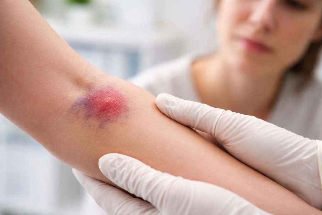 découvrez les conséquences d'une prise de sang mal faite, les causes de la douleur et du gonflement, et les conseils pour bien réagir et soulager les symptômes.