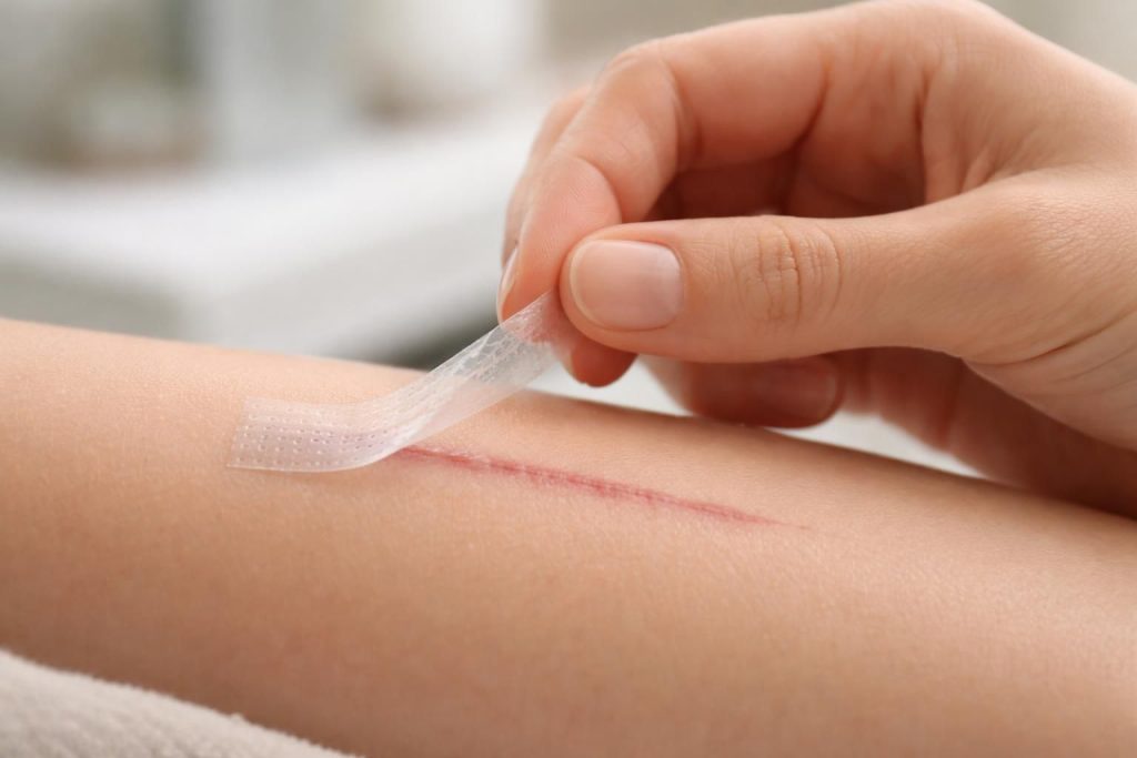 découvrez quand et comment retirer les steri-strips pour assurer une cicatrisation optimale et préserver votre cicatrice intacte.